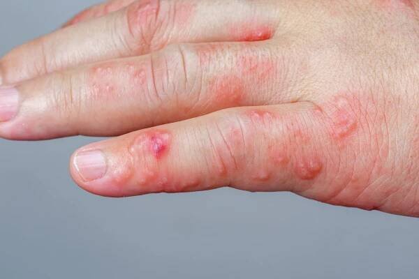 příznaky pásových oparů, zoster nebo herpes zoster na paži - ganglion - stock snímky, obrázky a fotky