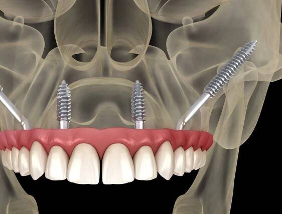 Clinical Indications: Atrophic Jaws