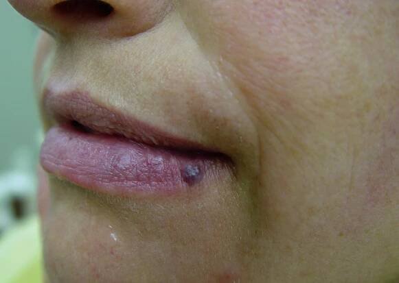 Acne & Rosacea – Lani Laser