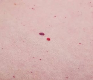 Hemangiom, microhematoma na lidské kůži, close-up, nemoc — Stock fotografie