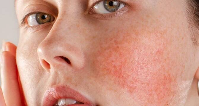 AD_IRRITATIONS_CHILD-IRRITATED-CHEEK-CREAM_LARGE_2021