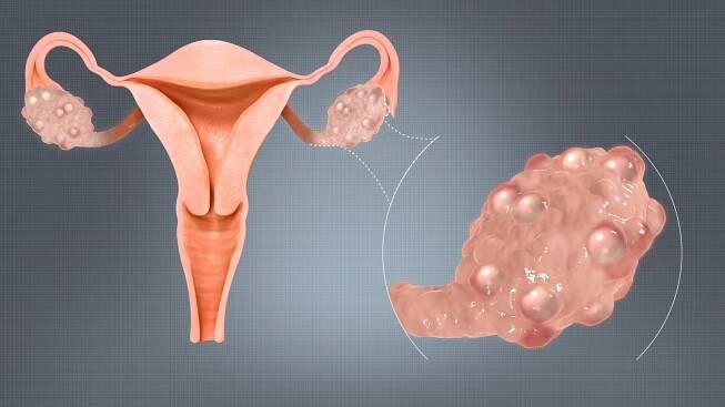 PCOS (syndrom polycystických ovarií) - co signalizuje, jaké má příznaky a jak jej řešit - Dr.Vitamin