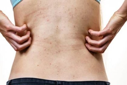 Svědění Kůže Dermatitida Alergie Jídlo Žena Ukazující Záda Akné Červené — Stock fotografie