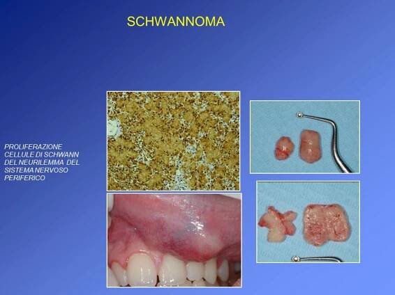 SCHWANNOMA 3
