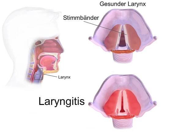 Bronchitida vs laryngitida: Rozdíl a srovnání