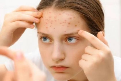 Portrét dospívající dívky se dotýká její tváře s pupínky, akné na kůži — Stock obrázek