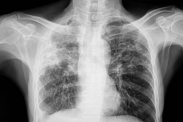 Rentgen hrudníku pacienta s tuberkulózou plic s retikulonodulární neprůhledností postihuje obě plíce od granulomatózní TBC infekce. — Stock obrázek