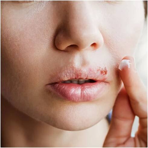 HERPES AROUND THE MOUTH