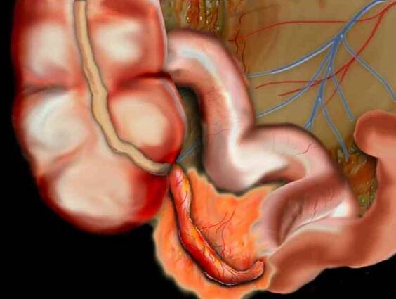 Flegmonózní apendicitida, co to je, příznaky a léčba patologie / Gastroenterologie | Užitečné informace a tipy na péči o