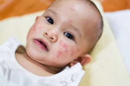 Vyrážka dítě alergii na obličej — Stock obrázek