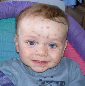 plané neštovice u dětí příznak