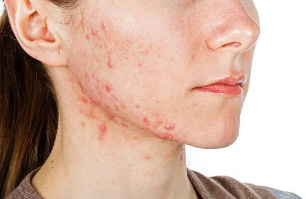 Best CBD for Acne - CBD Clinicals