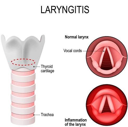 laryngitida. normální a zanícený hrtan - příklopka hrtanová stock ilustrace