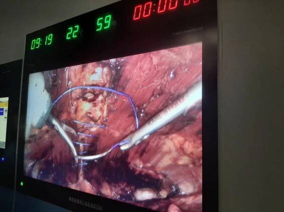 Operace břišní kýly a diastázy přímých břišních svalů