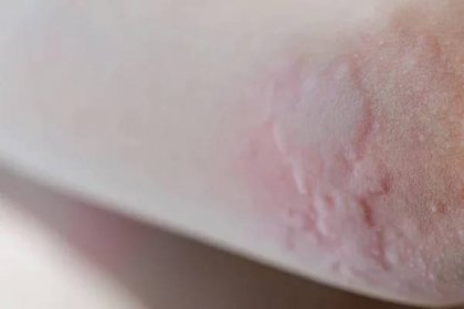 Kopřivka na kůži. Červené tečky alergické reakce na kůži dítěte. Symptomy kopřivky zavřít. — Stock obrázek