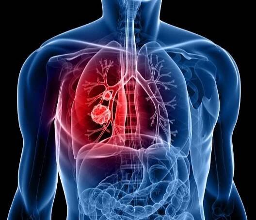 Lung Cancer - FOCP