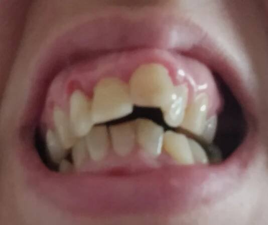 Dajú sa krivé zuby vyrovnať aj v dospelosti? - Modrý koník