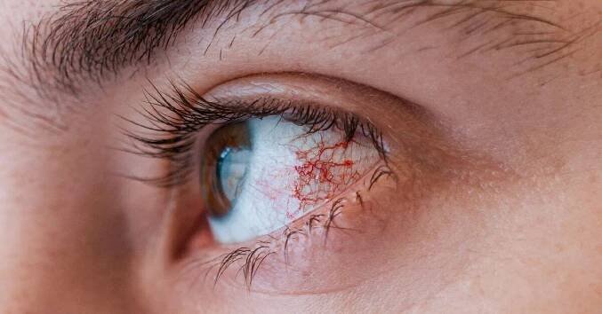 What Does Pink Eye Look Like?