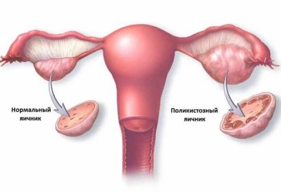 Nejdůležitější informace o syndromu polycystických vaječníků / Články