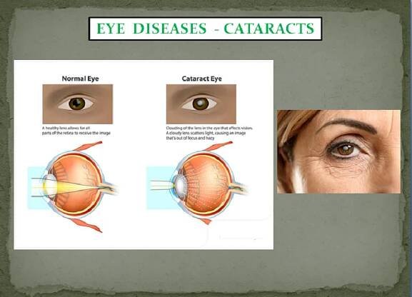 EYE PROBLEMS PACKAGE