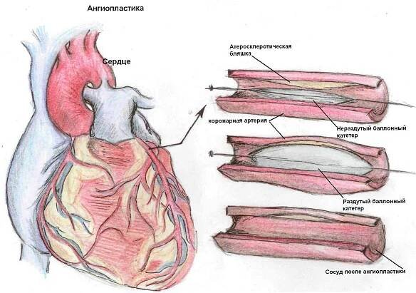 Příznaky infarktu myokardu, diagnóza, metody léčby a nouzová péče o infarkt / Kardiologie | Užitečné informace a tipy na