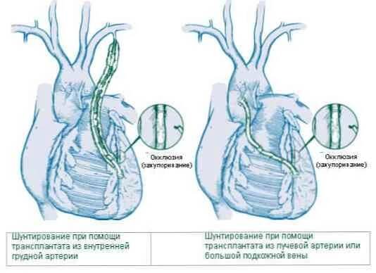 Operace bypassu koronární arterie a pooperační období / Kardiologie | Užitečné informace a tipy na péči o sebe. Zdraví