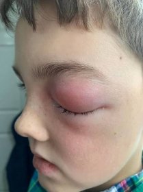 Chlapec (9) s „covidovým okem“ málem přišel o zrak. Vánoce strávil v nemocnici