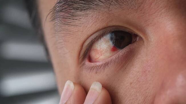 Close up image of a broken blood vessel in the eye