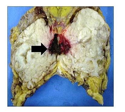 Phyllodes tumor - Wikipedia