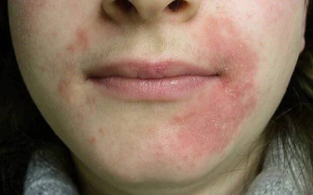 Trápí vás periorální dermatitida? Jak ji poznat, proč vzniká a jak se jí zbavit | Vitalpoint lékárna