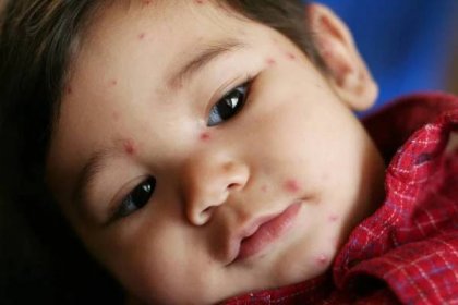 Pozor na dětskou vyrážku: Může znamenat i vážnou nemoc