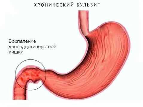 Duodenální bulba příznaky, diagnóza a léčebné pokyny / Gastroenterologie | Užitečné informace a tipy na péči o sebe. Zdraví