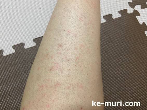 湘南美容クリニックのメンズ下半身脱毛初回。【口コミ】 | 毛、無理.com