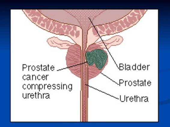 Seminars: Understanding Prostate Cancer - Christ Hospital Ministry