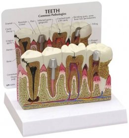 Model zubů a dásní