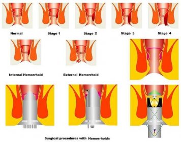 Přehled jednotlivých stádií hemoroidů doplněný ilustrací jejich operativního odstranění.