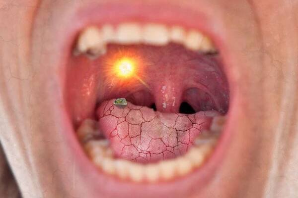Why Does My Mouth Feel Dry With Braces?
