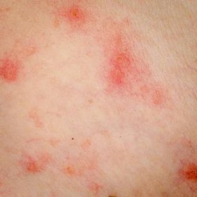 Alergická vyrážka dermatitida ekzémy kůže — Stock fotografie