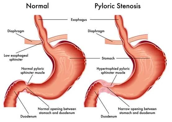 Vektorová ilustrace pylorické stenózy, koncepce anatomie — Ilustrace