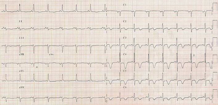 ECG inverted T wave unstable angina pectoris, stenosis RIA, RCx