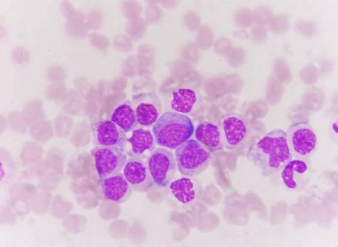 Rakovina krve: Jaké jsou její příznaky a jak se jí vyhnout