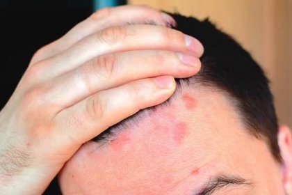 Atopická dermatitida na pokožce hlavy: Jak se liší od lupů a lupénky