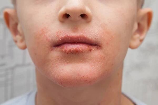 atopická kůže na chlapecké tváři. lidská kůže, představující alergickou reakci, alergickou vyrážku na obličeji a rtech. - dermatitida - stock snímky, obrázky a fotky