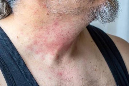 Alergie kůže dermatitida jídlo. vyrážka s příznaky dětské dermatitidy. tvář spaní atopický symptom na kůži — Stock obrázek