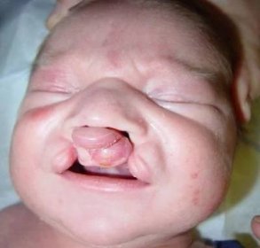 Jaromírek (4) se narodil s rozštěpem - Po čtyřech operacích se konečně usmívá