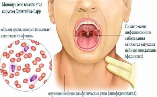 Infekční symptomy mononukleózy, diagnóza, léčba / Infekční onemocnění | Užitečné informace a tipy na péči o sebe. Zdraví