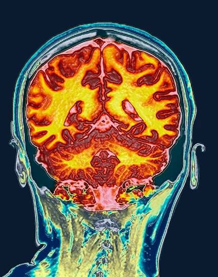 The real science of brain rot | National Geographic