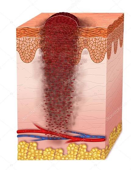Metastáza melanomu