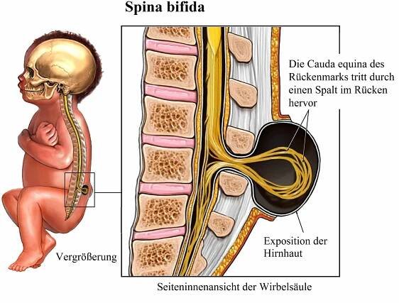 Spina bifida