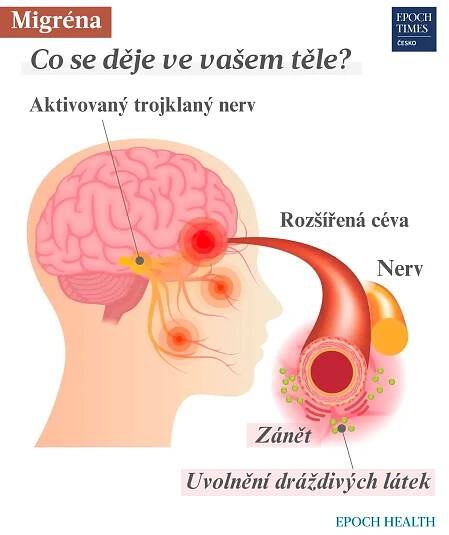 Migréna: Příznaky, příčiny, léčba a přírodní metody